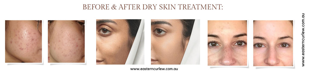 Before After Dry Skin Treatment | Eastern Curlew