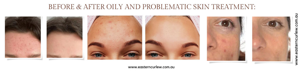 Before After Oily and Problematic Skin treatment |Eastern Curlew