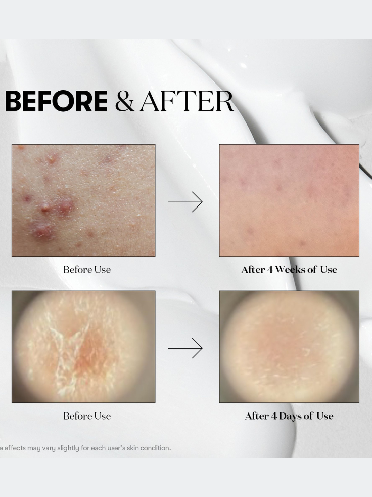 Before and after skin treatment results showing improvement over time.