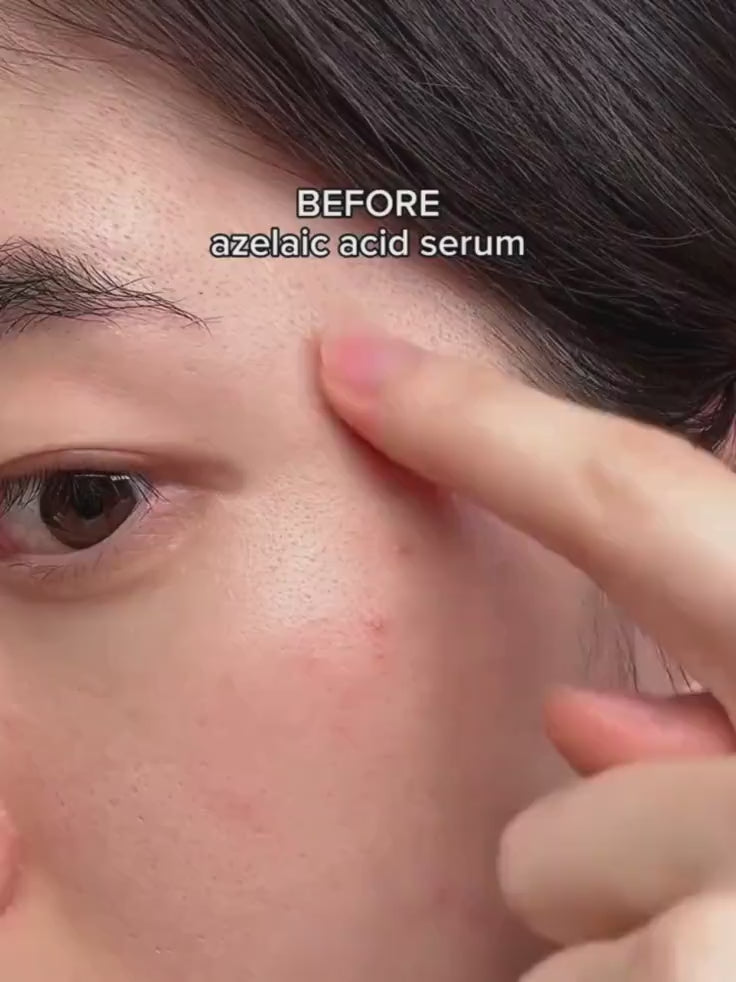 K-Beauty serum: Anua Azelaic Acid with Hyaluronic Acid for calm, clear skin.